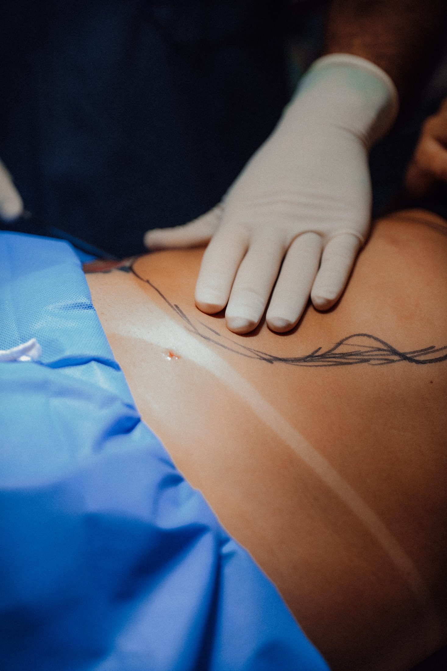 Abdominoplastia — Hospital Espaço da Plástica